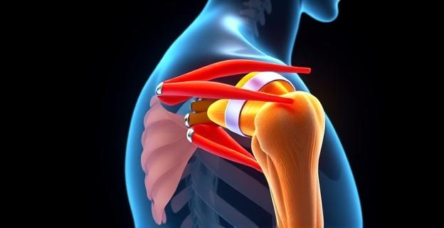 Imagen de una articulación del hombro con los músculos del manguito rotador resaltados en diferentes colores, mostrando su disposición anatómica y función en el movimiento del brazo